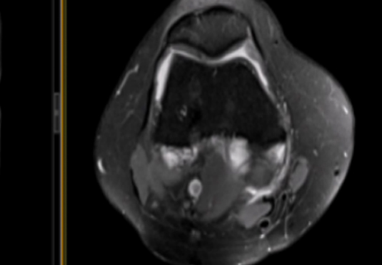 微创射频消融术